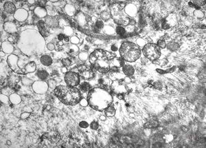 F,25y. | myopathy - atrophic and regenerating muscle cells F,25y. | myopathy - atrophic and regenerating muscle cells